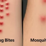 Symtoms Bed Bug Bites vs Mosquito Bites Thorough Property Inspection MA Pest Control LLP / pest control in kolkata / pest control in kolkata / best control in kolkata/